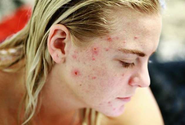 ways-to-heal-acne-scars-faster-plixlife