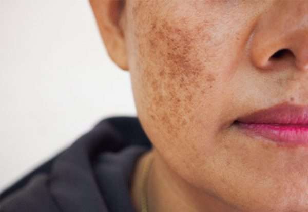 Blemishes On Face - Types, Causes & Remedies - Plix